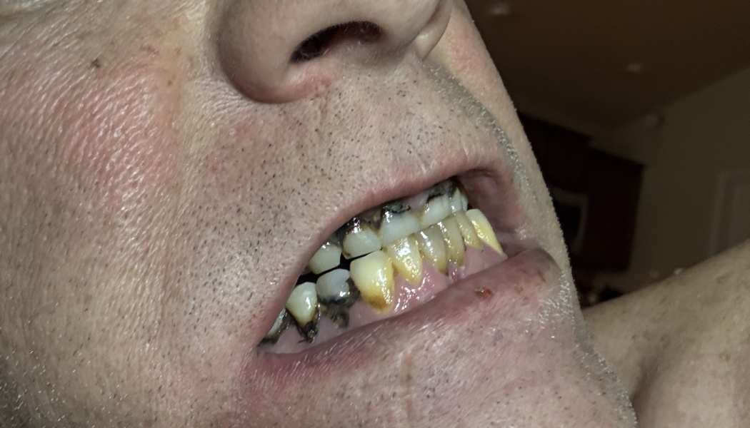 Close-up view of a person's mouth showing severely stained and decaying teeth with visible rot near the gums.