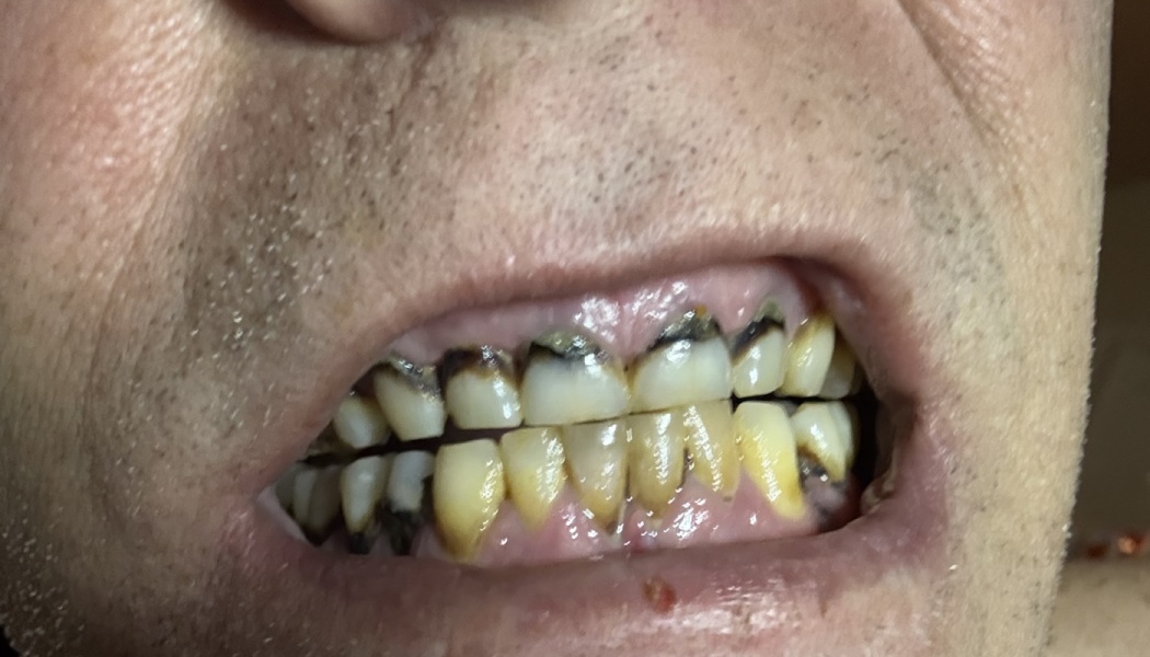 Close-up of a person's teeth showing severe decay, dark staining at the gum line, and heavy discoloration.