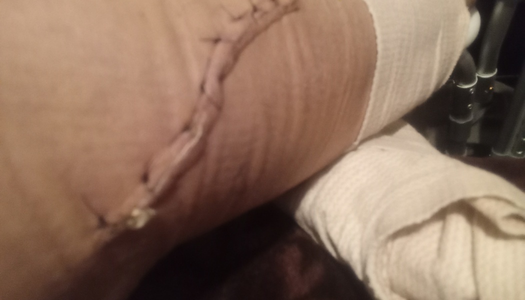 A long surgical incision with stitches on a person's limb, resting near white medical bandages.