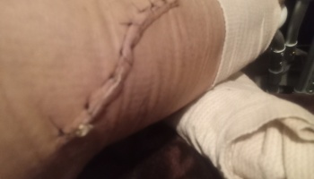 A long surgical incision with stitches on a person's limb, resting near white medical bandages.