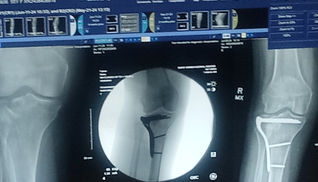 Medical X-ray on a monitor displaying a knee repaired with a surgical metal plate and screws.