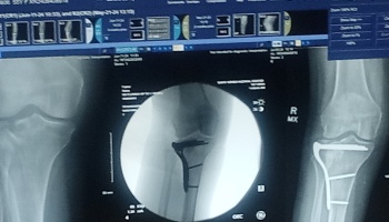 Medical X-ray on a monitor displaying a knee repaired with a surgical metal plate and screws.