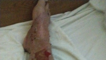 A lower leg and foot with severe skin scarring and open wounds resting on a white bed sheet.