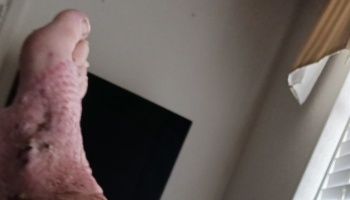 A human foot with severe red, bumpy, and inflamed skin rash.