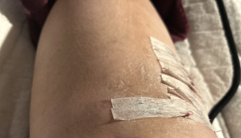 Close-up of a healing surgical incision secured with white steri-strips.