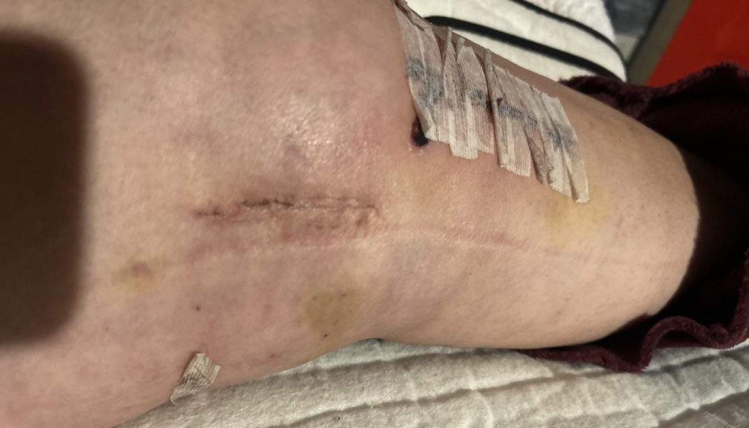 Surgical incisions and bruising on a person's leg with steri-strips after surgery.