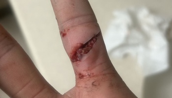 A deep laceration on the base of a finger exposing underlying tissue and blood.