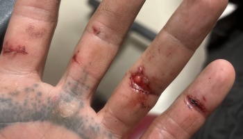 A tattooed hand with multiple bloody cuts and lacerations across the fingers.