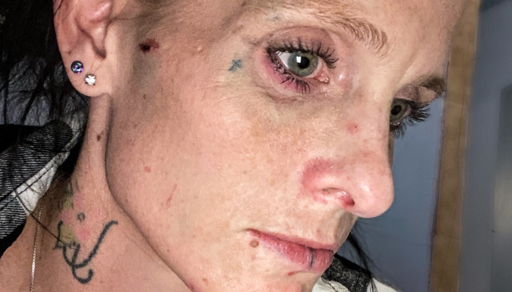Close-up of a woman's face showing small cuts near her temple, a red nose, irritated eyes, and neck tattoos.