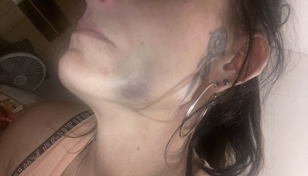 Close-up profile of a person's lower cheek and jawline showing a dark purple bruise.