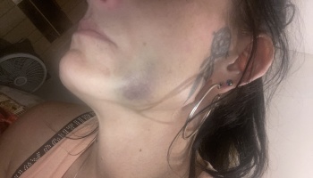 Close-up profile of a person's lower cheek and jawline showing a dark purple bruise.