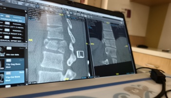 Computer screen displaying CT scans showing a spine fracture.