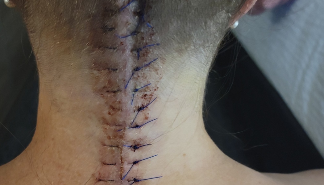 Vertical surgical incision closed with blue stitches running down the back of a person's neck.
