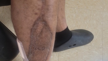 Close-up of a person's lower leg showing a large, healed surgical scar and skin graft.