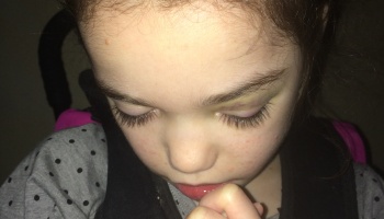 Close-up of a young child with closed eyes, showing yellow and purple bruising around her left eyelid.