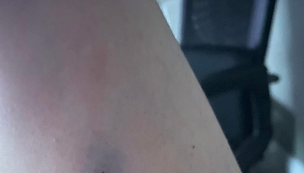 Close-up of skin showing a small dark purple bruise and slight redness.
