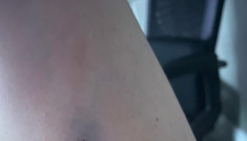 Close-up of skin showing a small dark purple bruise and slight redness.