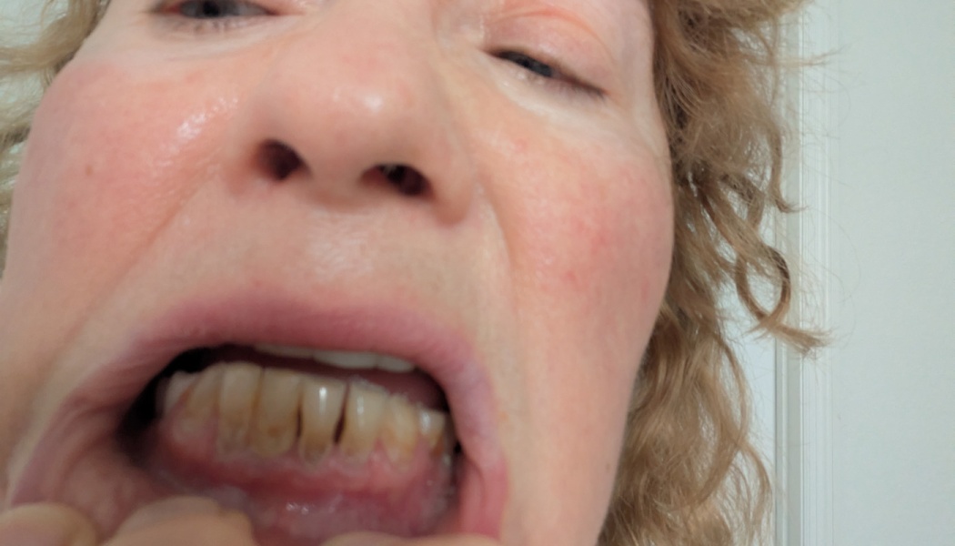 Close-up of a woman pulling down her lower lip to show discolored, damaged lower teeth and inflamed gums.
