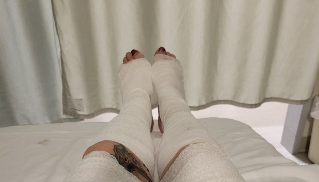 Person lying in a hospital bed with both legs and feet heavily wrapped in white medical bandages.