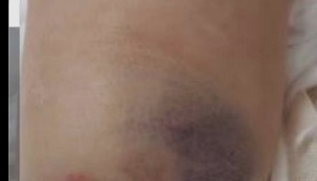 Close-up of a large, dark purple bruise on light skin.