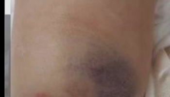 Close-up of a large, dark purple bruise on light skin.