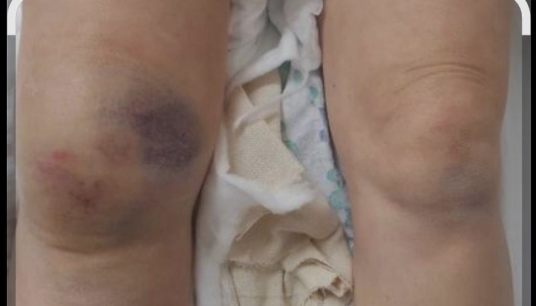 A person's injured knees with a large dark purple bruise and red scrapes on the left knee.