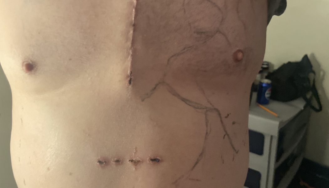 A person's chest showing a long vertical surgical scar down the sternum and smaller incision marks on the abdomen.