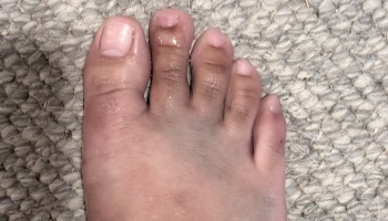 A bare foot on a carpet showing an injured second toe with peeling skin and dark bruising across the top of the foot.