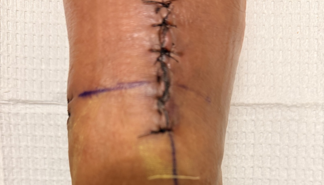 Close-up of a surgical incision with black sutures and purple surgical guidelines on skin.