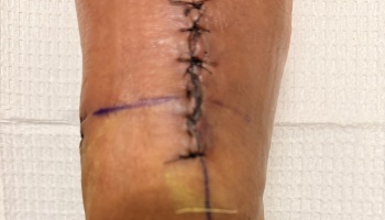 Close-up of a surgical incision with black sutures and purple surgical guidelines on skin.