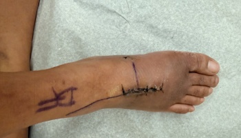 A swollen foot with dark sutures along a surgical incision and purple medical skin markings.
