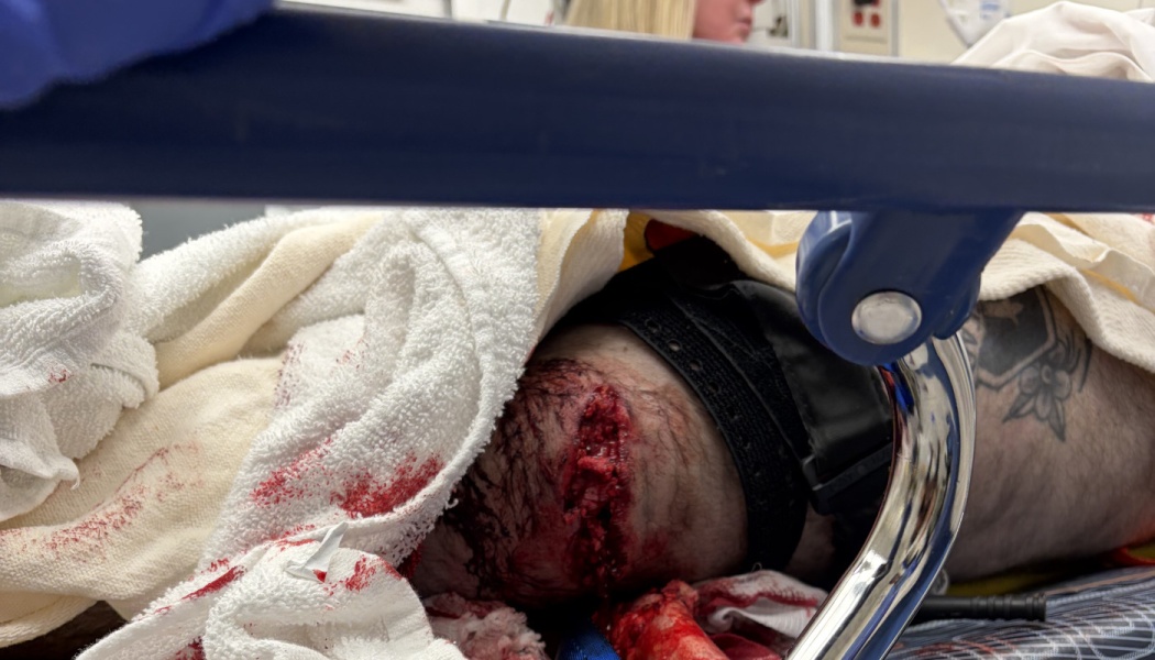 A patient on a hospital stretcher with a severe open leg injury, bloody towels, and a tourniquet applied.