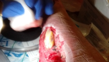 A gloved hand cleaning a large, open wound with exposed tissue on a person's limb.