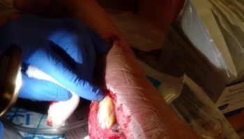 A gloved hand applying gauze near a severe, deep open wound during medical treatment.
