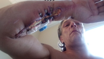 A man holds up his arm to show a severe surgical wound with staples along his inner forearm.
