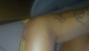 Close-up of a tattooed limb with a healing surgical incision and yellow medical tape.