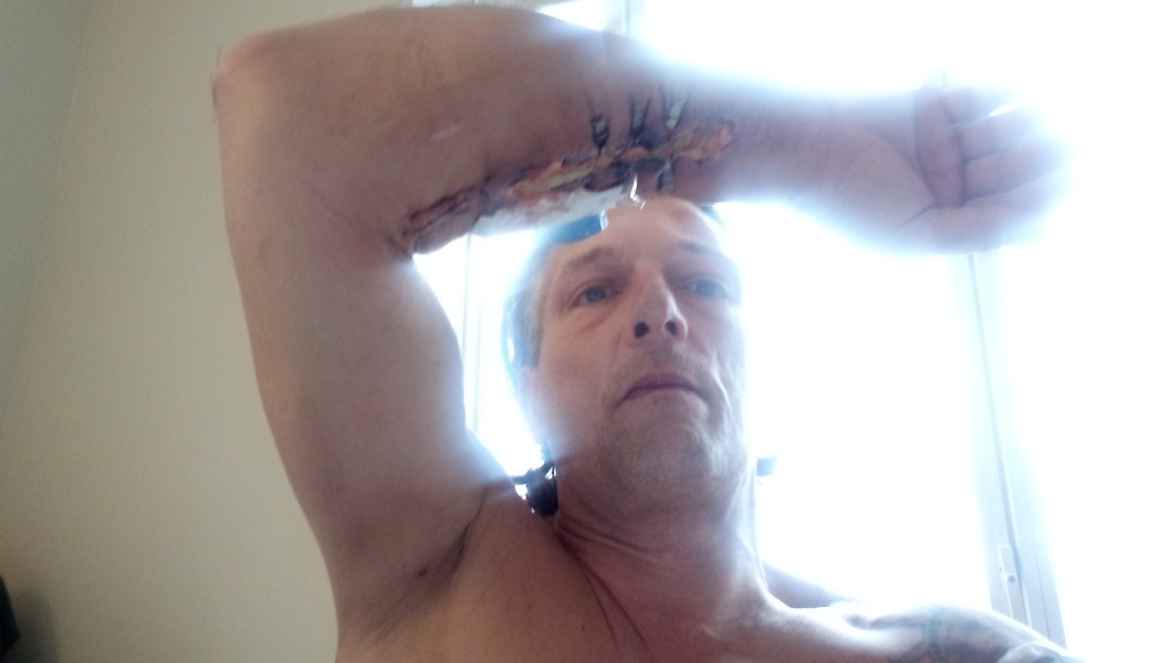 A man holding up his arm to reveal a long surgical incision with staples on his forearm.