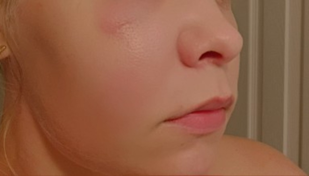 Close-up of a person's face showing a small scar and redness on their cheek below the eye.
