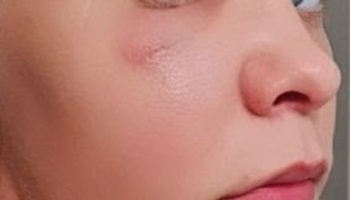 Close-up of a person's face showing a small red scar or mark on their cheek below the eye.