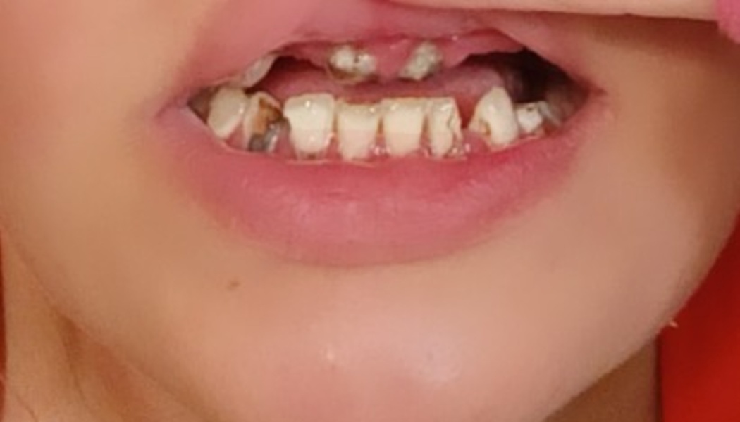 Close-up of an open mouth showing severe dental decay and damage to both upper and lower teeth.