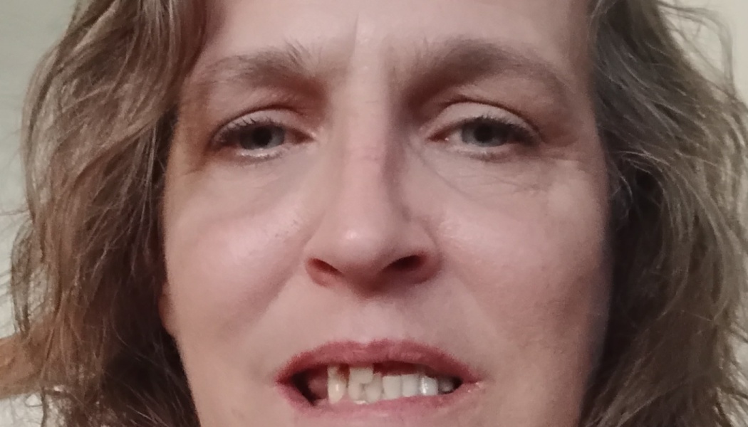 Close-up portrait of a woman with wavy hair looking forward, showing visible damage to her upper teeth.