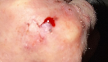 Close-up of irritated skin with a small open wound bleeding bright red blood.