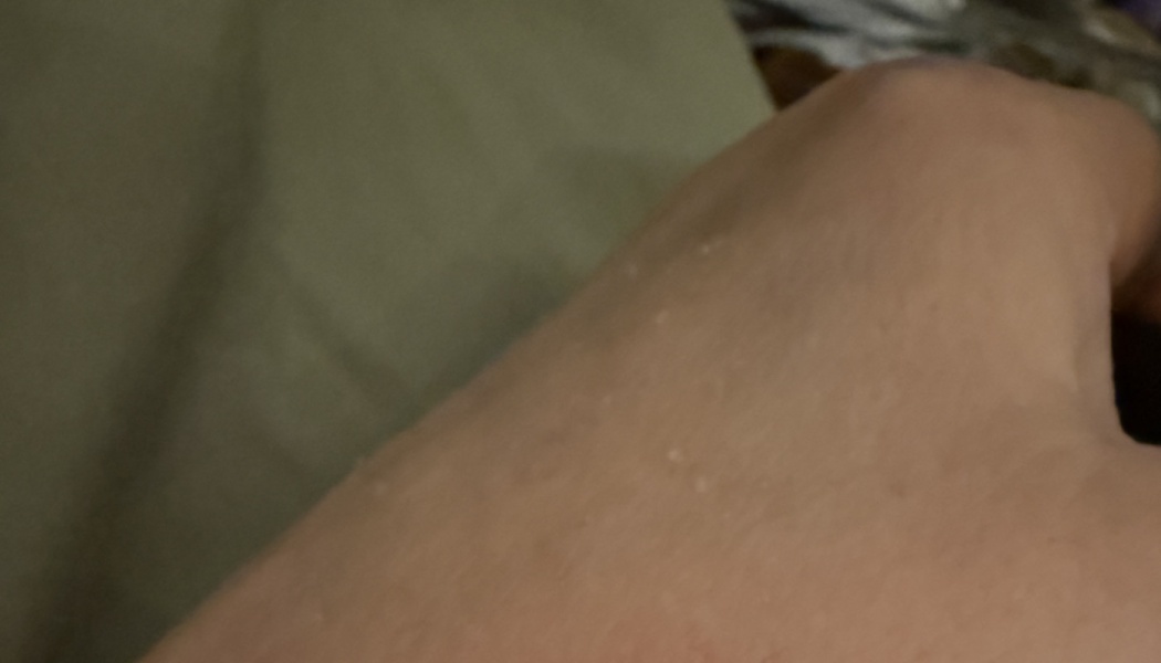 Close-up of skin on a hand showing small white bumps against a dark background.