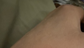 Close-up of skin on a hand showing small white bumps against a dark background.