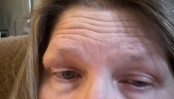 Close-up of a person's face showing tired grey eyes and a furrowed, wrinkled forehead.