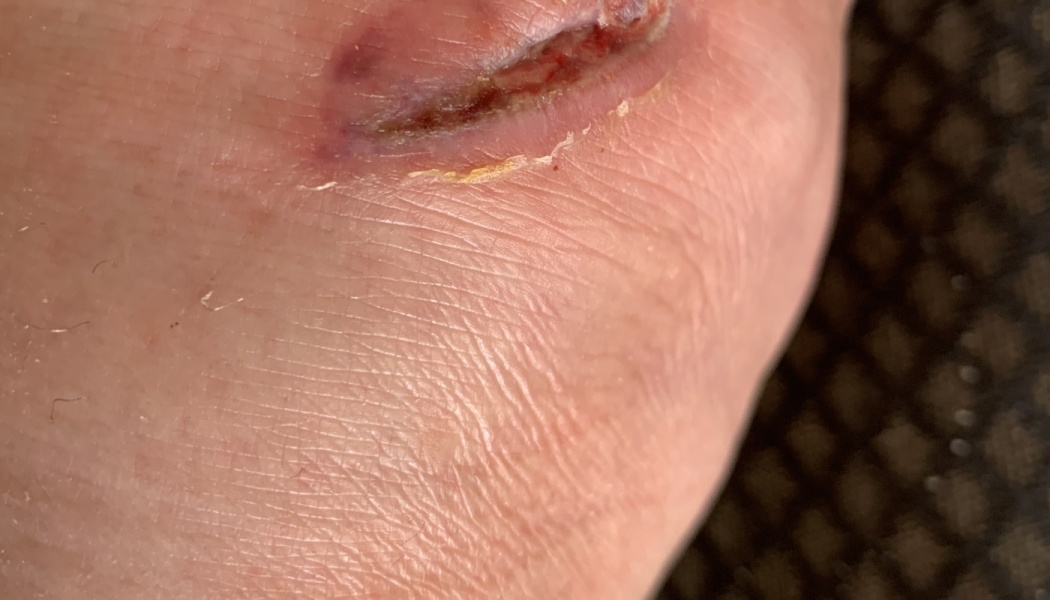 Close-up of a deep skin laceration with surrounding redness and peeling skin.