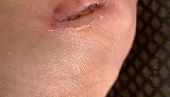 Close-up of a deep skin laceration with surrounding redness and peeling skin.