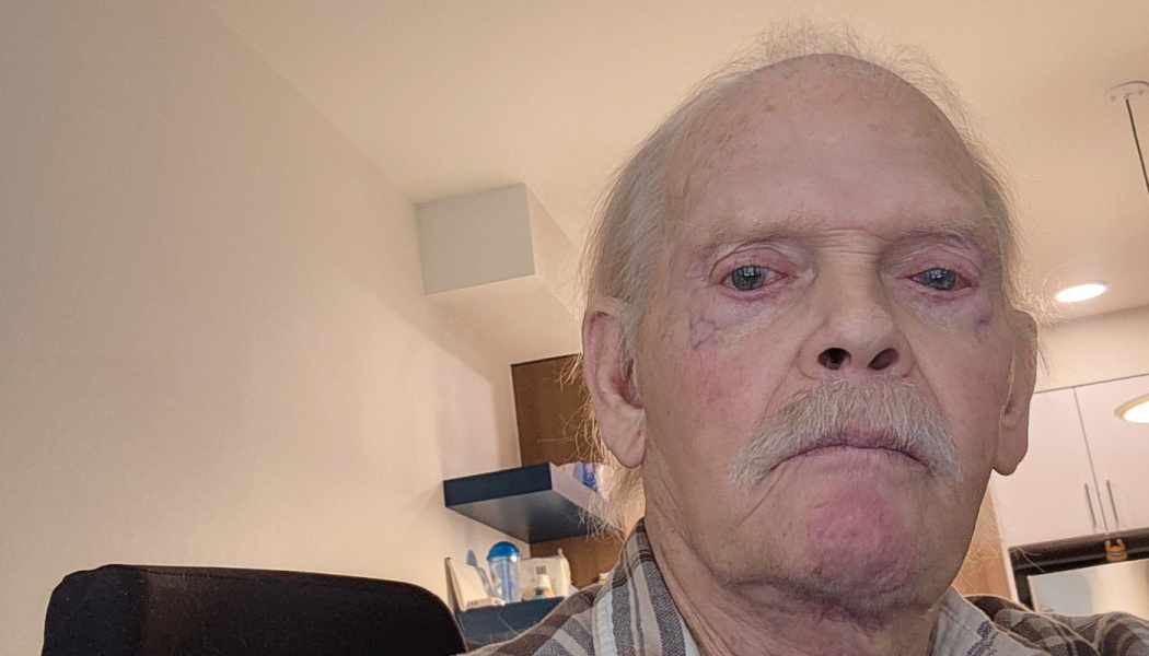 Close-up of an elderly man with thin white hair, a mustache, and noticeable redness around his eyes.