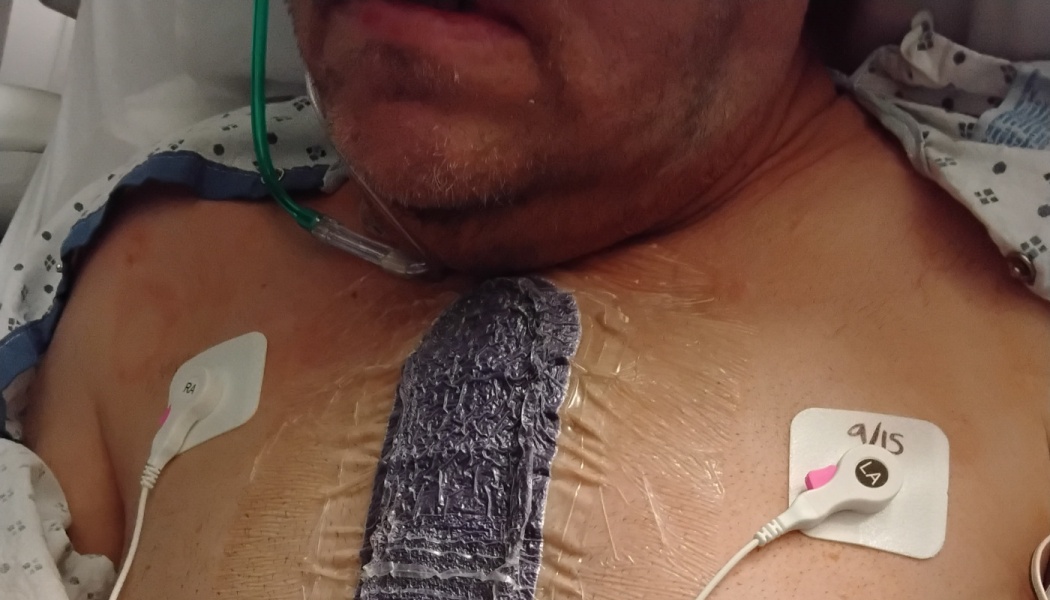 A hospital patient's chest with a large surgical dressing down the center, heart monitor pads, and a cannula.