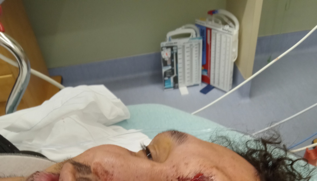 A person lying in a hospital bed with visible facial injuries and medical equipment in the background.